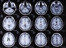 Riconoscere l'Alzheimer